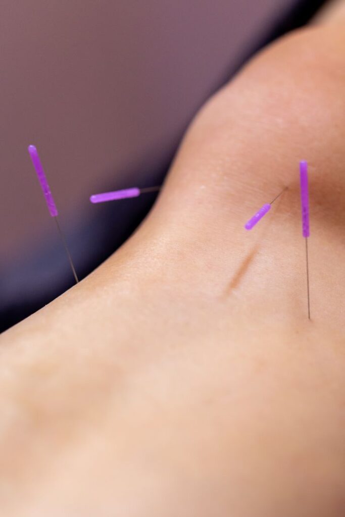 Acupunctuurnaald