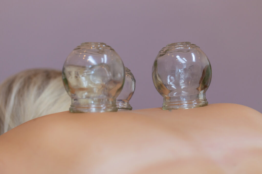 cupping